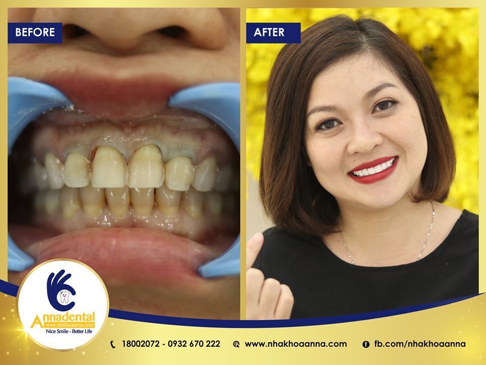 Hình ảnh bọc răng sứ - Nha khoa Anna – Ca 19