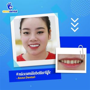 Hình ảnh dán sứ Veneer của KH D.T – Nha khoa Anna – Ca 2