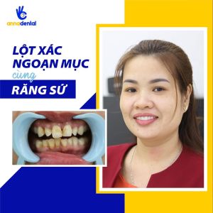Hình ảnh bọc răng sứ - Nha khoa Anna – Ca 3