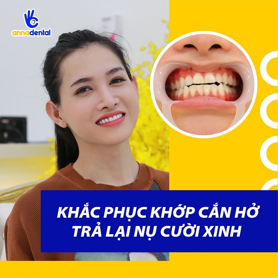 Hình ảnh bọc răng sứ của KH Mỹ Linh – Nha khoa Anna – Ca 4