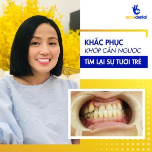 Hình ảnh bọc răng sứ Lava plus của KH Tuệ Mẫn – Nha khoa Anna – ca 5