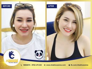 Hình ảnh bọc răng sứ - Nha khoa Anna – ca 6