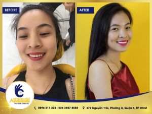 Hình ảnh bọc răng sứ Cercon – Nha khoa Anna – Ca 9
