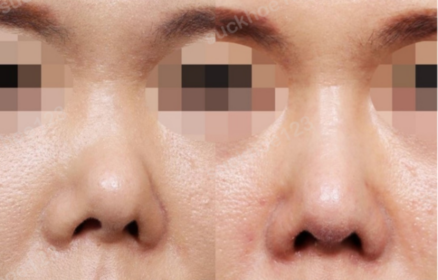 ảnh trước sau PT mũi bị co rút 1