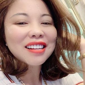 Hình ảnh bọc răng sứ của KH Thanh Vân – Nha khoa BeDental – Ca 10