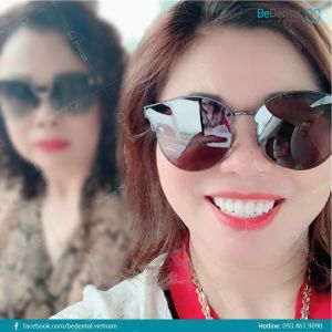 Hình ảnh bọc răng sứ của KH Thanh Vân – Nha khoa BeDental – Ca 10