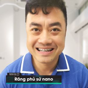 Hình ảnh bọc răng sứ - Nha khoa BeDental – Ca 12