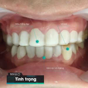 Hình ảnh bọc răng sứ - Nha khoa BeDental – Ca 12