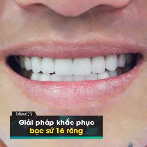 Hình ảnh bọc răng sứ - Nha khoa BeDental – Ca 12
