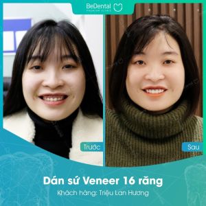 Hình ảnh dán sứ Veneer của KH Triệu Lan Hương – Nha khoa BeDental – Ca 13