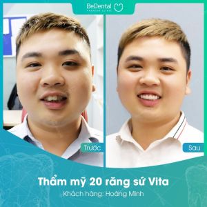 Hình ảnh bọc răng sứ của KH Hoàng Minh – Nha khoa BeDental – Ca 14