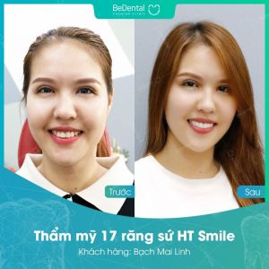 Hình ảnh bọc răng sứ của KH Bạch Mai Linh – Nha khoa BeDental – Ca 15