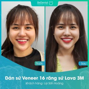 Hình ảnh dán sứ Veneer của KH Lại Sơn Hoàng – Nha khoa BeDental – Ca 18