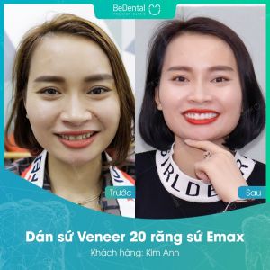 Hình ảnh dán sứ Veneer của Kim Anh – Nha khoa BeDental – Ca 19