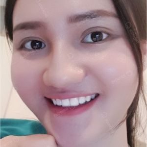 Hình ảnh dán sứ Veneer kết hợp tẩy trắng răng của KH Mỹ Linh – Nha khoa BeDental – Ca 1