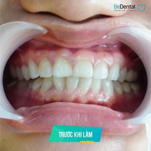 Hình ảnh dán sứ Veneer kết hợp tẩy trắng răng của KH Mỹ Linh – Nha khoa BeDental – Ca 1