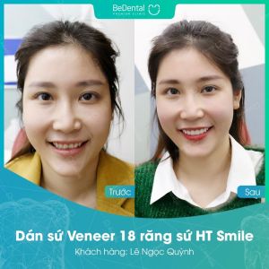 Hình ảnh dán sứ Veneer của KH Lê Ngọc Quỳnh – Nha khoa BeDental – Ca 20