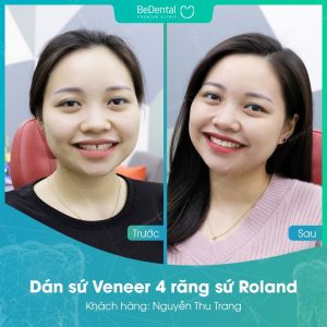 Hình ảnh dán sứ Veneer của KH Nguyễn Thu Trang – Nha khoa BeDental – Ca 21