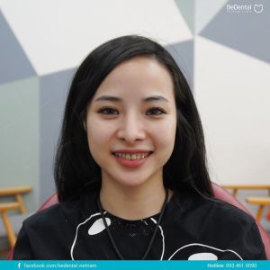 Hình ảnh dán sứ Veneer – Nha khoa BeDental – Ca 2