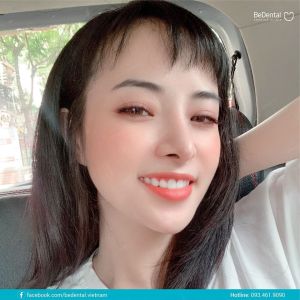 Hình ảnh dán sứ Veneer – Nha khoa BeDental – Ca 2