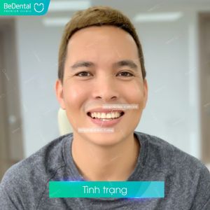 Hình ảnh dán sứ Veneer – Nha khoa BeDental – Ca 3