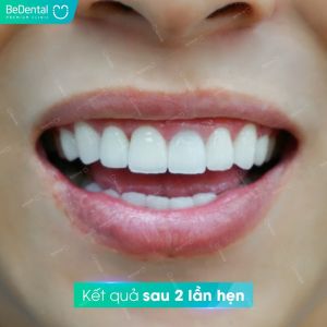 Hình ảnh dán sứ Veneer – Nha khoa BeDental – Ca 3