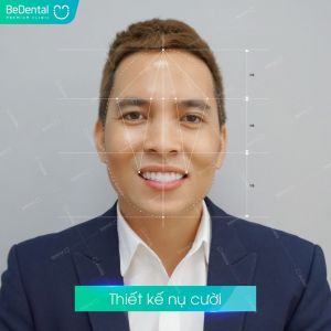 Hình ảnh dán sứ Veneer – Nha khoa BeDental – Ca 3