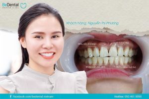 Hình ảnh dán sứ Veneer của KH Nguyễn Thị Phương – Nha khoa BeDental – Ca 4