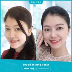 Hình ảnh bọc răng sứ của KH Nguyễn Minh Trâm – Nha khoa BeDental – Ca 5