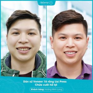 Hình ảnh dán sứ Veneer của KH Hoàng Minh Long – Nha khoa BeDental – Ca 6