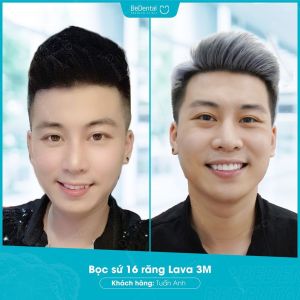 Hình ảnh bọc răng sứ của KH Tuấn Anh – Nha khoa BeDental – Ca 7