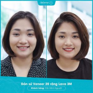 Hình ảnh dán sứ Veneer của KH Trần Minh Nguyệt – Nha khoa BeDental – Ca 8