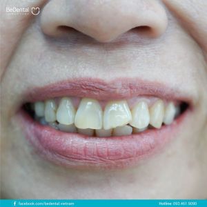 Hình ảnh bọc răng sứ của KH Ngọc Hoa – Nha khoa BeDental – Ca 9