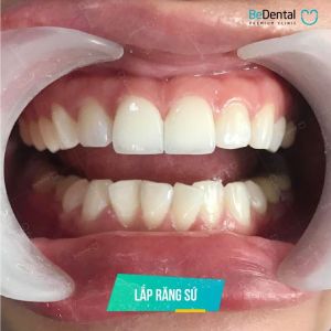 Hình ảnh dán sứ Veneer kết hợp tẩy trắng răng của KH Mỹ Linh – Nha khoa BeDental – Ca 1