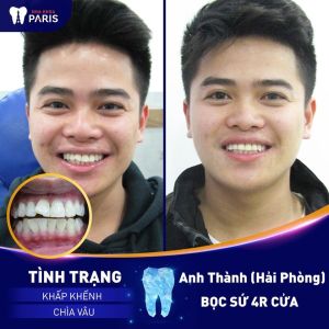 Hình ảnh bọc răng sứ của KH anh Thành – Ca 47
