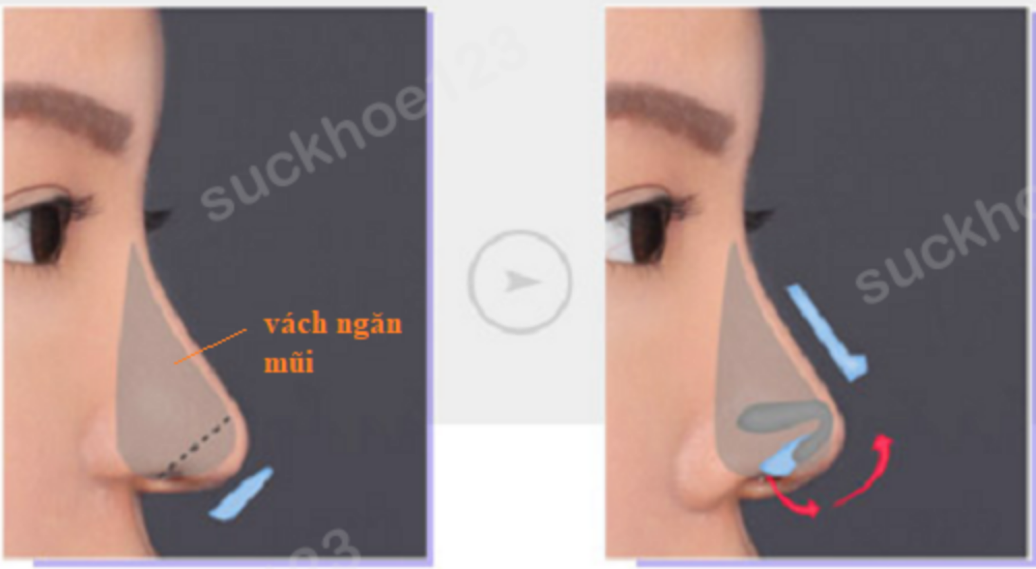 cắt bỏ bớt vách ngăn mũi