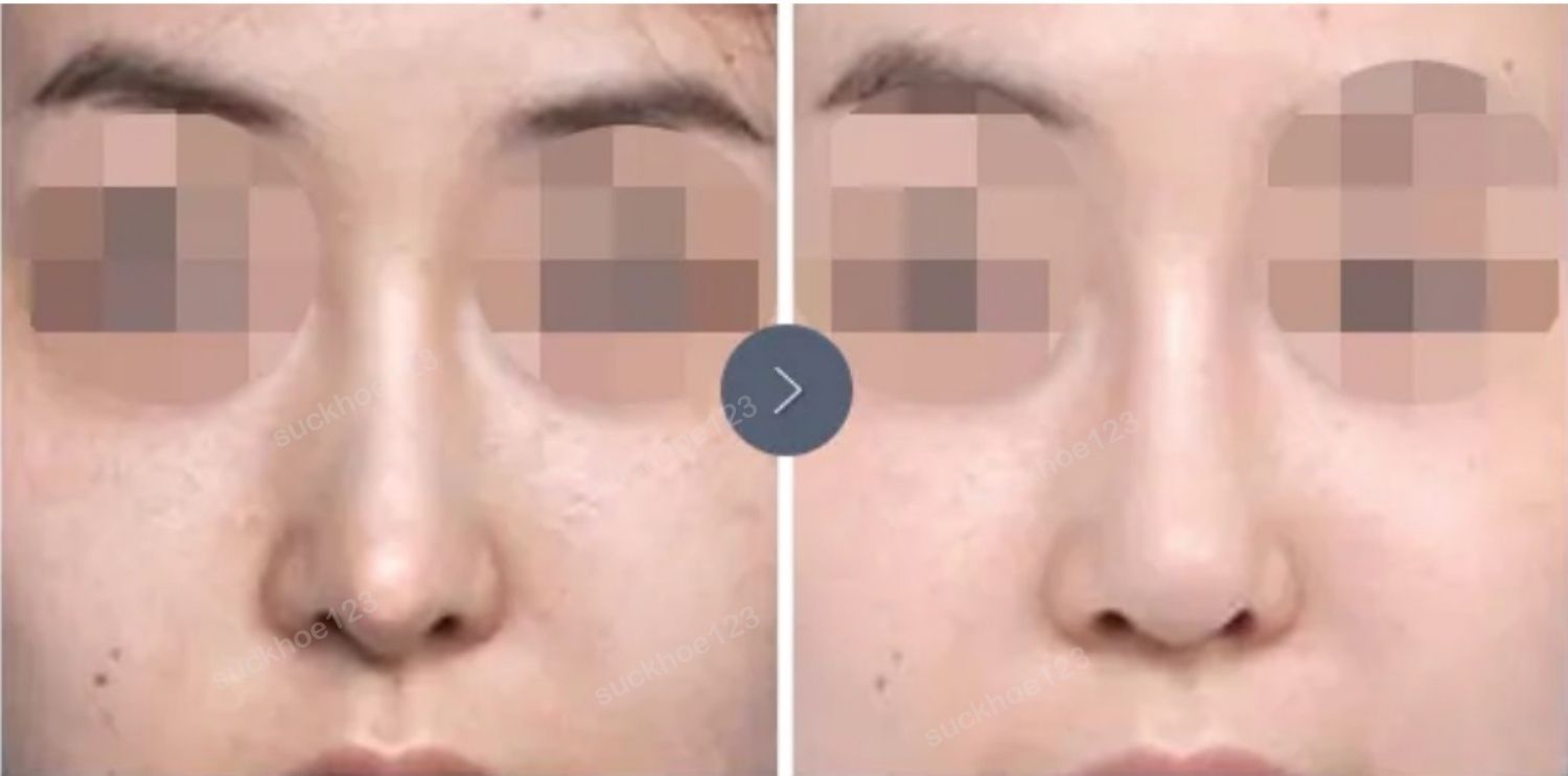đầu mũi dài do tụt sụn