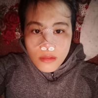 Vừa nâng mũi về sao đau nhức quá