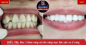 Hình ảnh bọc răng sứ - Nha khoa Đông Nam – Ca 1