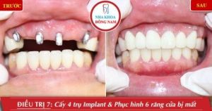 Hình ảnh trồng răng implant của chị K.Thúy – Nha khoa Đông Nam – Ca 11
