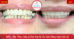 Hình ảnh bọc răng sứ của KH T.Linh – Nha khoa Đông Nam – Ca 12