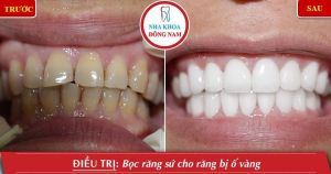 Hình ảnh bọc răng sứ - Nha khoa Đông Nam – Ca 2