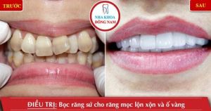 Hình ảnh bọc răng sứ của chị Hằng – Nha khoa Đông Nam – Ca 3