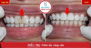 Hình ảnh bọc răng sứ của chị Hà - Nha khoa Đông Nam – Ca 4