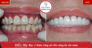 Hình ảnh bọc răng sứ của chị Quỳnh – Nha khoa Đông Nam – Ca 6