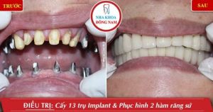 Hình ảnh trồng răng implant của KH H.Vinh – Nha khoa Đông Nam – Ca 7