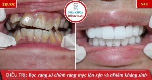 Hình ảnh bọc răng sứ của KH H.K.Huyền – Nha khoa Đông Nam – Ca 8
