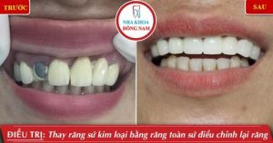 Hình ảnh bọc răng sứ của chị K.Tuyến – Nha khoa Đông Nam – Ca 9