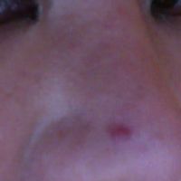 1 năm sau phẫu thuật nâng mũi: đây là mụn trứng cá hay silicone nâng mũi bị nhiễm trùng?