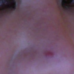 1 năm sau phẫu thuật nâng mũi: đây là mụn trứng cá hay silicone nâng mũi bị nhiễm trùng?